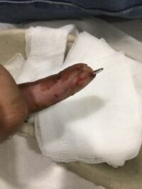 Μετεγχειρητική εικόνα στις 4 εβδομάδες