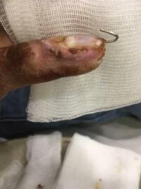 Μετεγχειρητική εικόνα στις 4 εβδομάδες