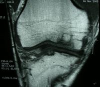 Αντικατάσταση της βλάβης με οστεοχονδρομόσχευμα (OATS) όπως φαίνεται στη μαγνητική τομογραφία μετά από 8 μήνες