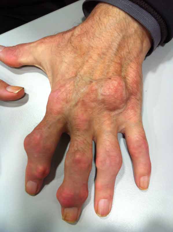 Ασθενής με ουρική αρθρίτιδα χεριών