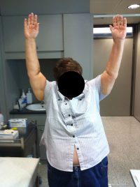 Ασθενής με συντριπτικό κάταγμα του Αριστερού ώμου