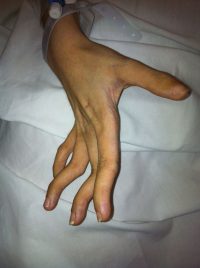 Σύνδρομο Enler-Danlos και πολλαπλά εξαρθρήματα επιγονατίδος