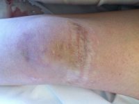 Σύνδρομο Enler-Danlos και πολλαπλά εξαρθρήματα επιγονατίδος