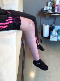 Σύνδρομο Enler-Danlos και πολλαπλά εξαρθρήματα επιγονατίδος