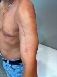 Επιτυχή επέμβαση με εσωτερική οστεοσύνθεση με αυτόλογα οστικά μοσχεύματα